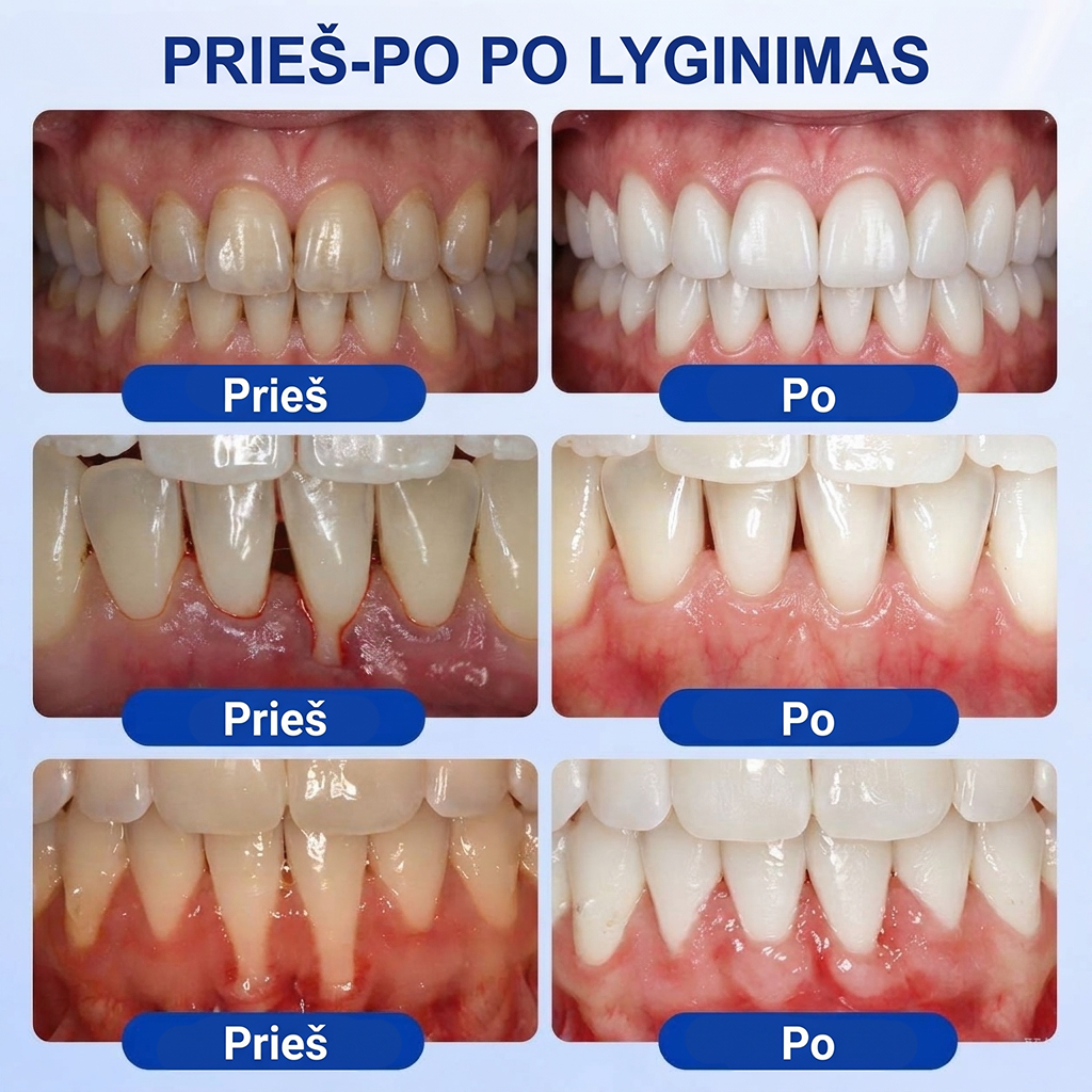 🦷 𝐏𝐮𝐫𝐚𝐂𝐮𝐫𝐞® DANTENŲ ATKŪRIMAS – Periodonto audinių regeneracijos gelis 🧂