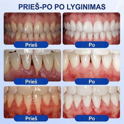 🦷 𝐏𝐮𝐫𝐚𝐂𝐮𝐫𝐞® DANTENŲ ATKŪRIMAS – Periodonto audinių regeneracijos gelis 🧂