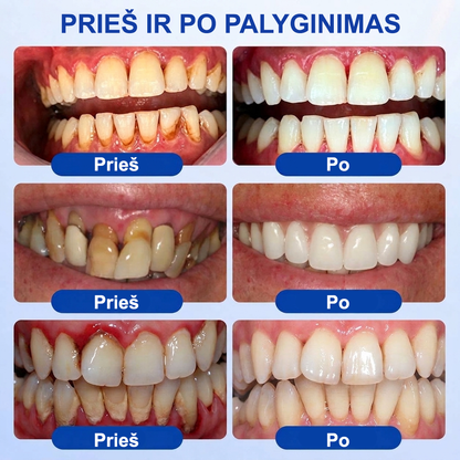 🦷 𝐏𝐮𝐫𝐚𝐂𝐮𝐫𝐞® DANTENŲ ATKŪRIMAS – Periodonto audinių regeneracijos gelis 🧂