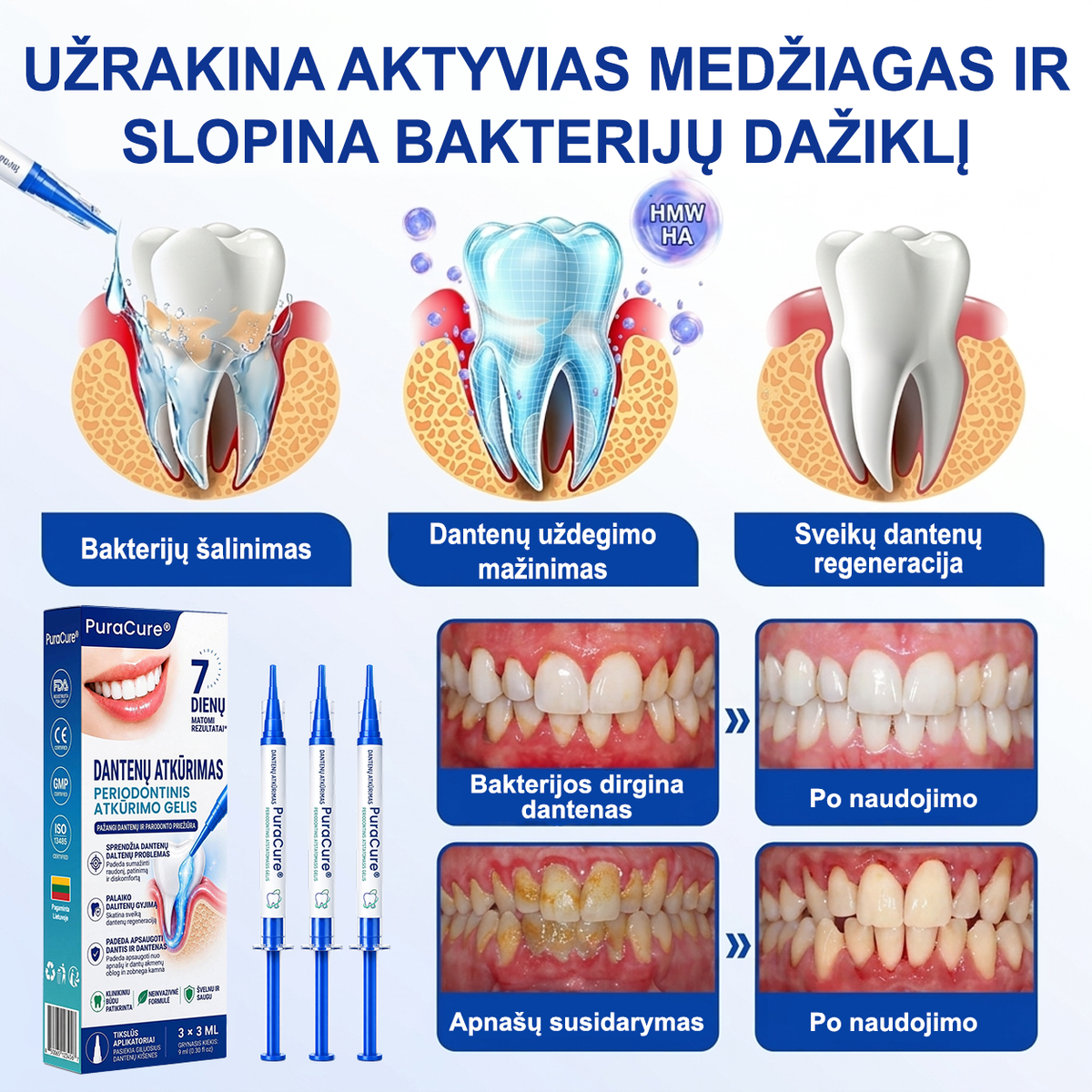 🦷 𝐏𝐮𝐫𝐚𝐂𝐮𝐫𝐞® DANTENŲ ATKŪRIMAS – Periodonto audinių regeneracijos gelis 🧂