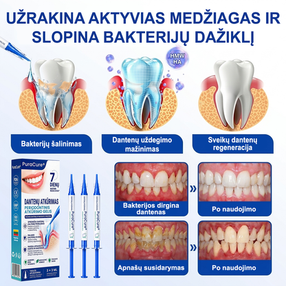 🦷 𝐏𝐮𝐫𝐚𝐂𝐮𝐫𝐞® DANTENŲ ATKŪRIMAS – Periodonto audinių regeneracijos gelis 🧂