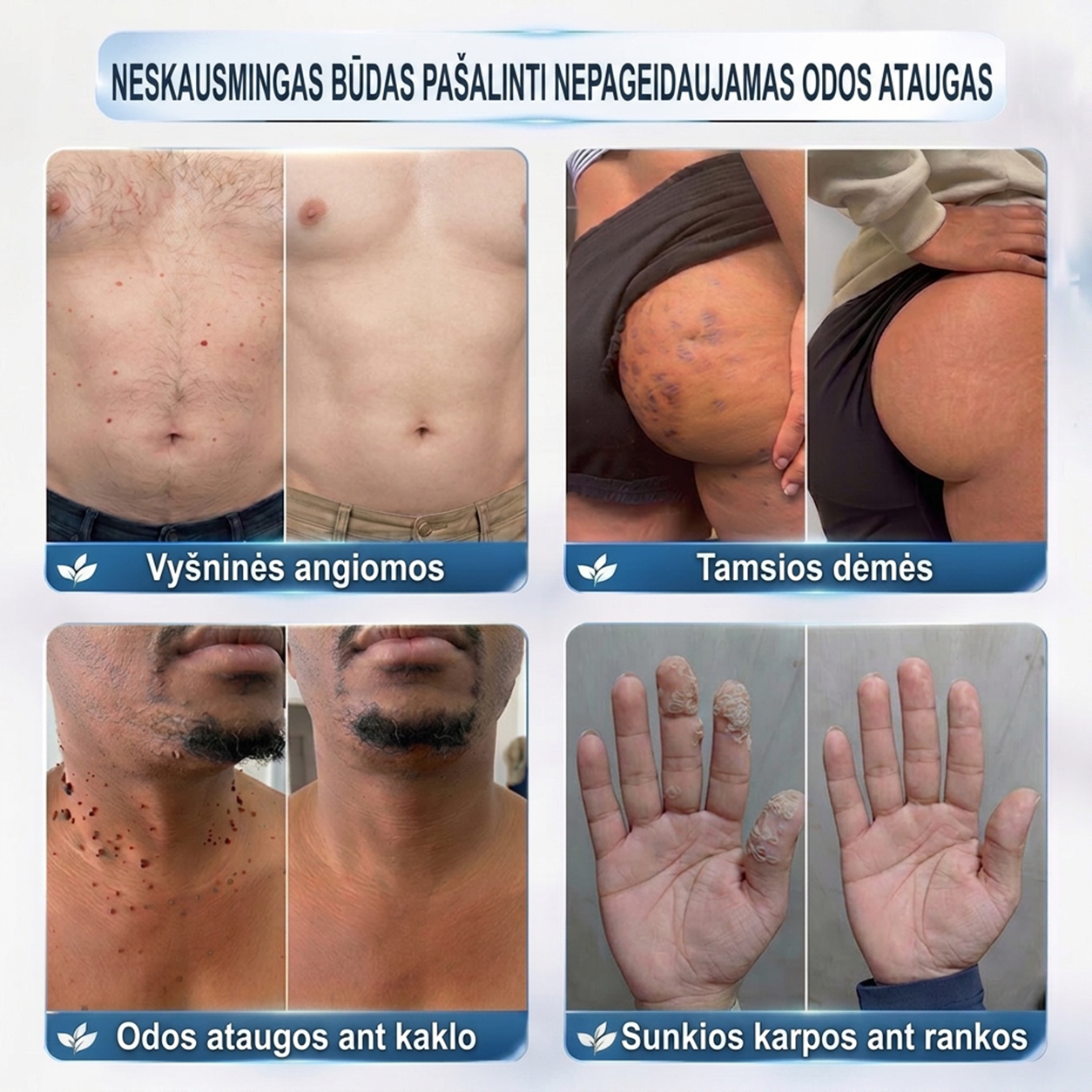 PuraCure® 👩‍⚕️ 7 dienų odos išaugų ir dėmių šalinimo pieštukas – neskausmingas, be randų, profesionalus ritininis aplikatorius